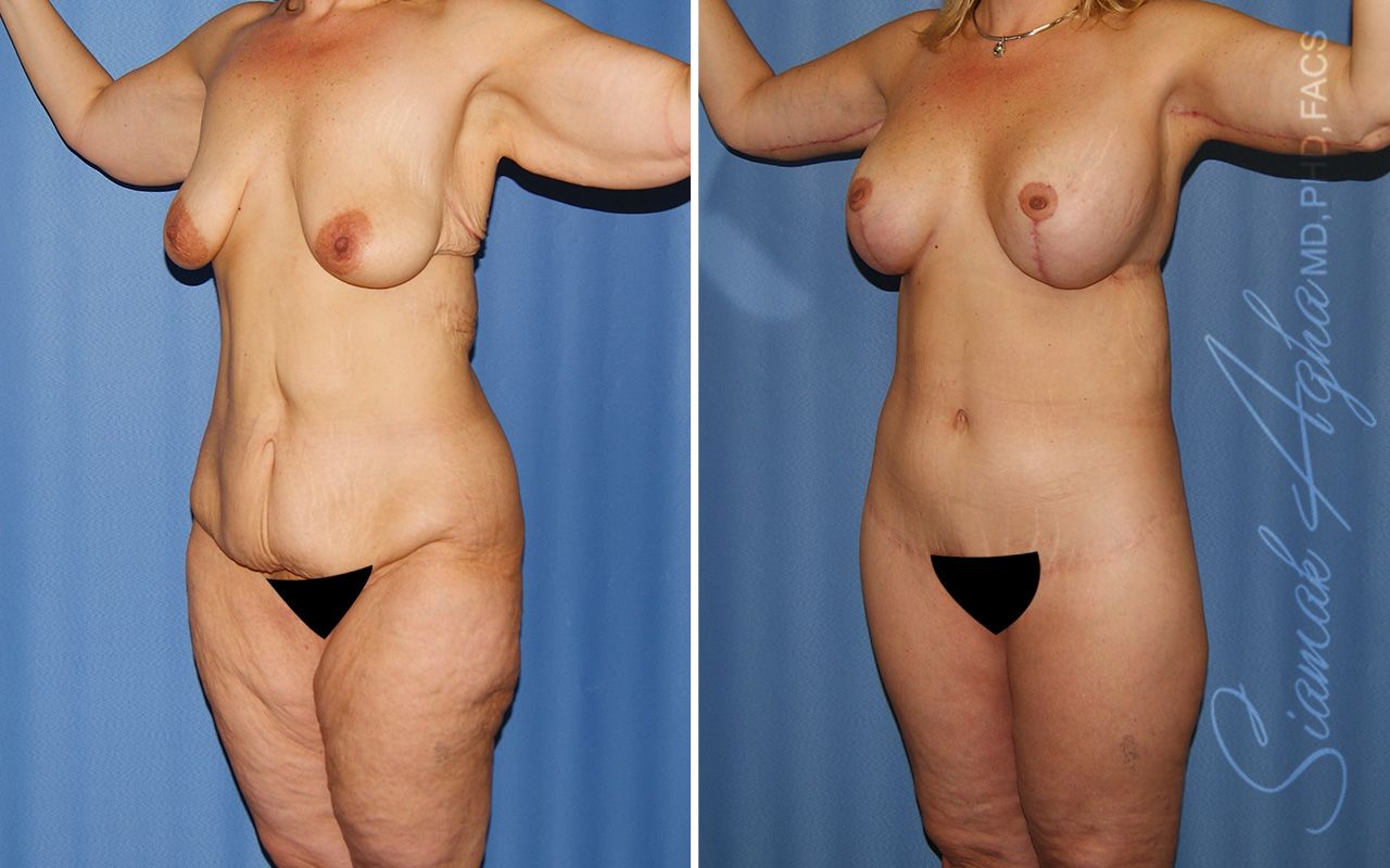 Total Body Lift Before & After