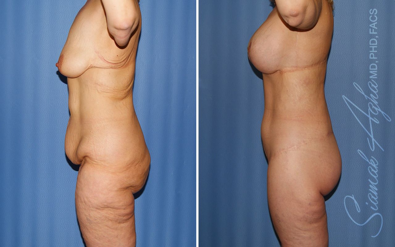 Total Body Lift Before & After