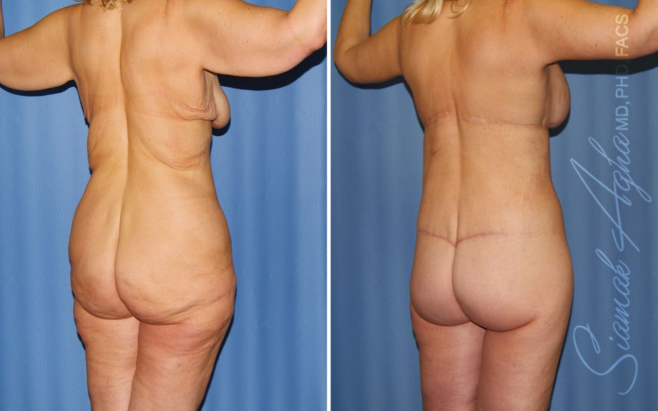 Total Body Lift Before & After