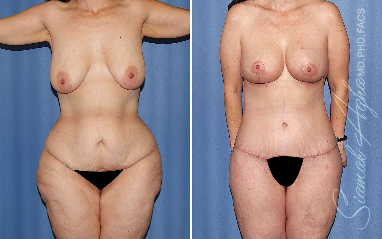 Total Body Lift Before & After