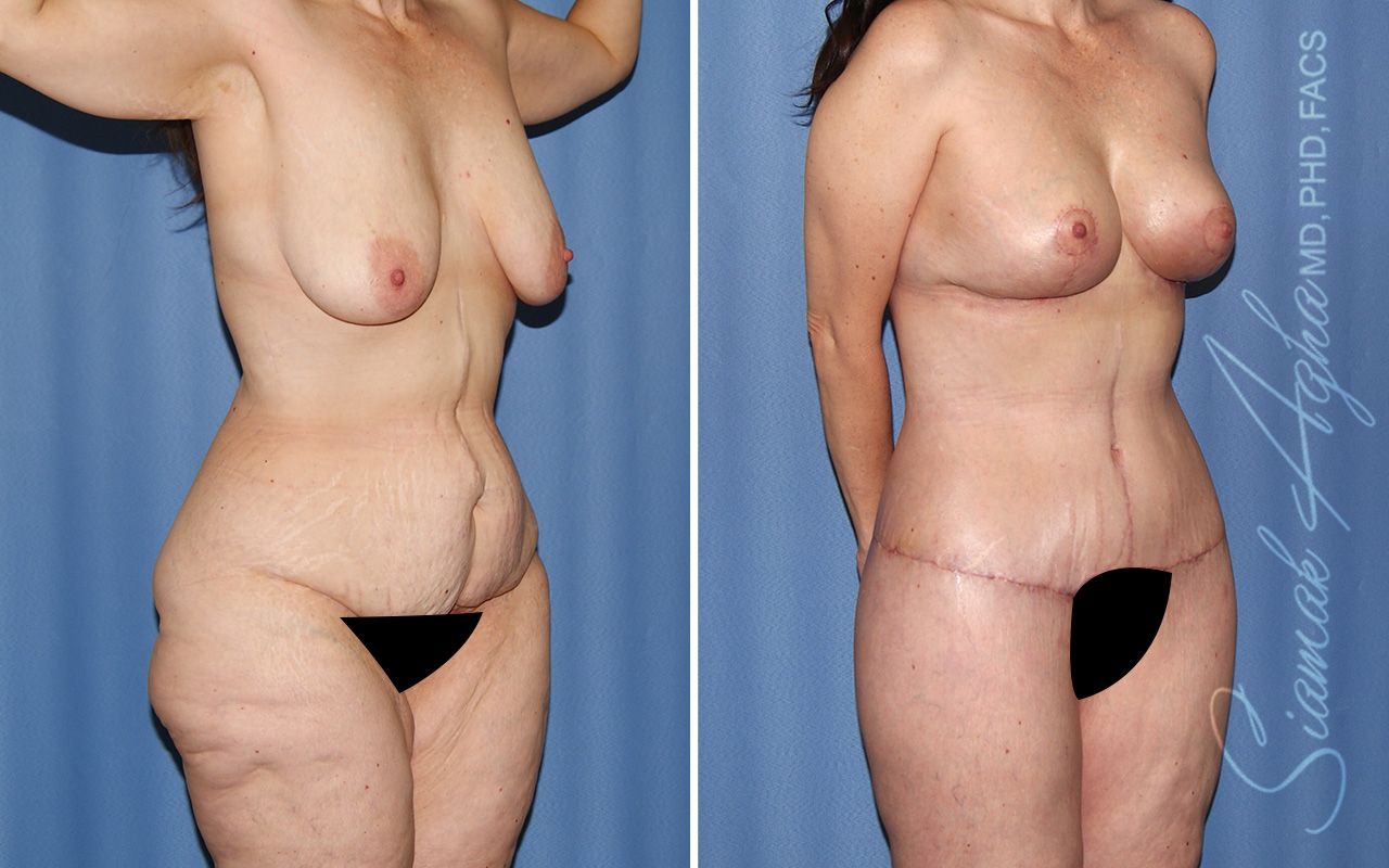 Total Body Lift Before & After