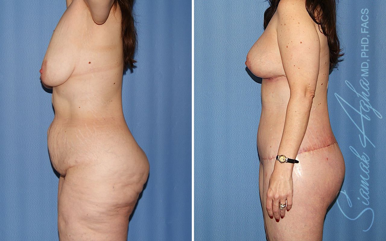 Total Body Lift Before & After