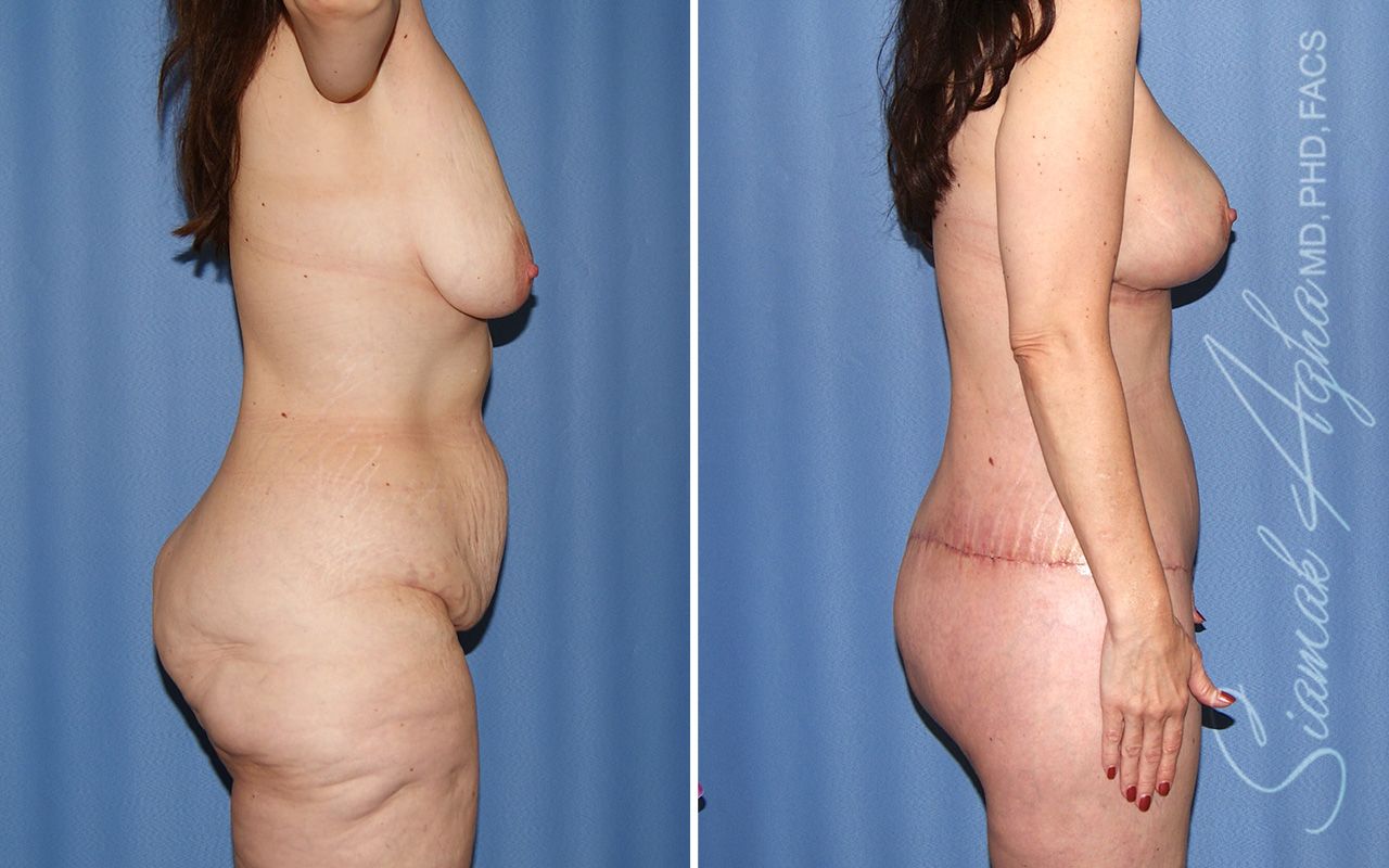 Total Body Lift Before & After