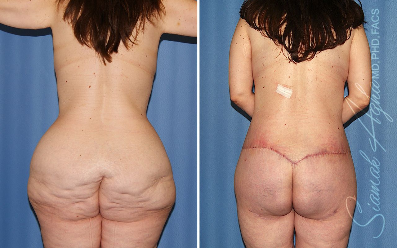 Total Body Lift Before & After