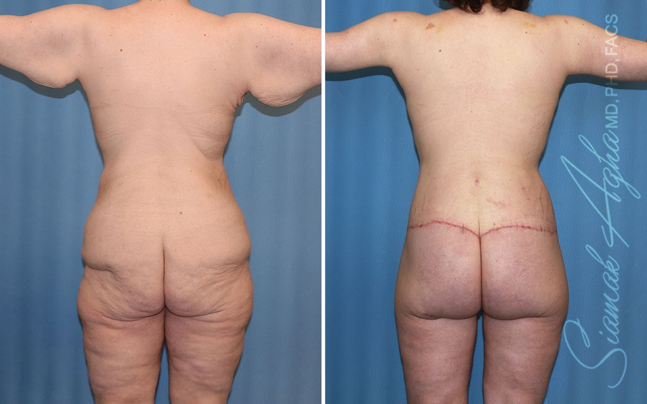 Total Body Lift Before & After