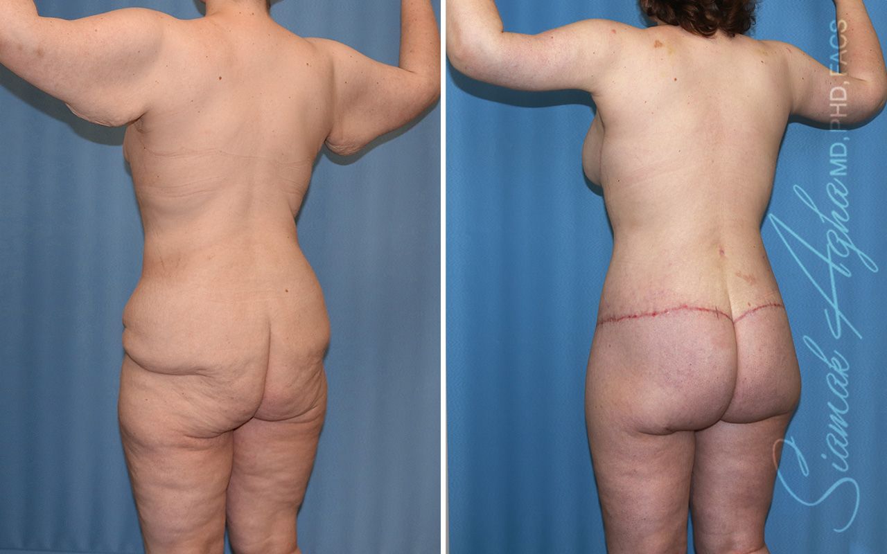 Total Body Lift Before & After