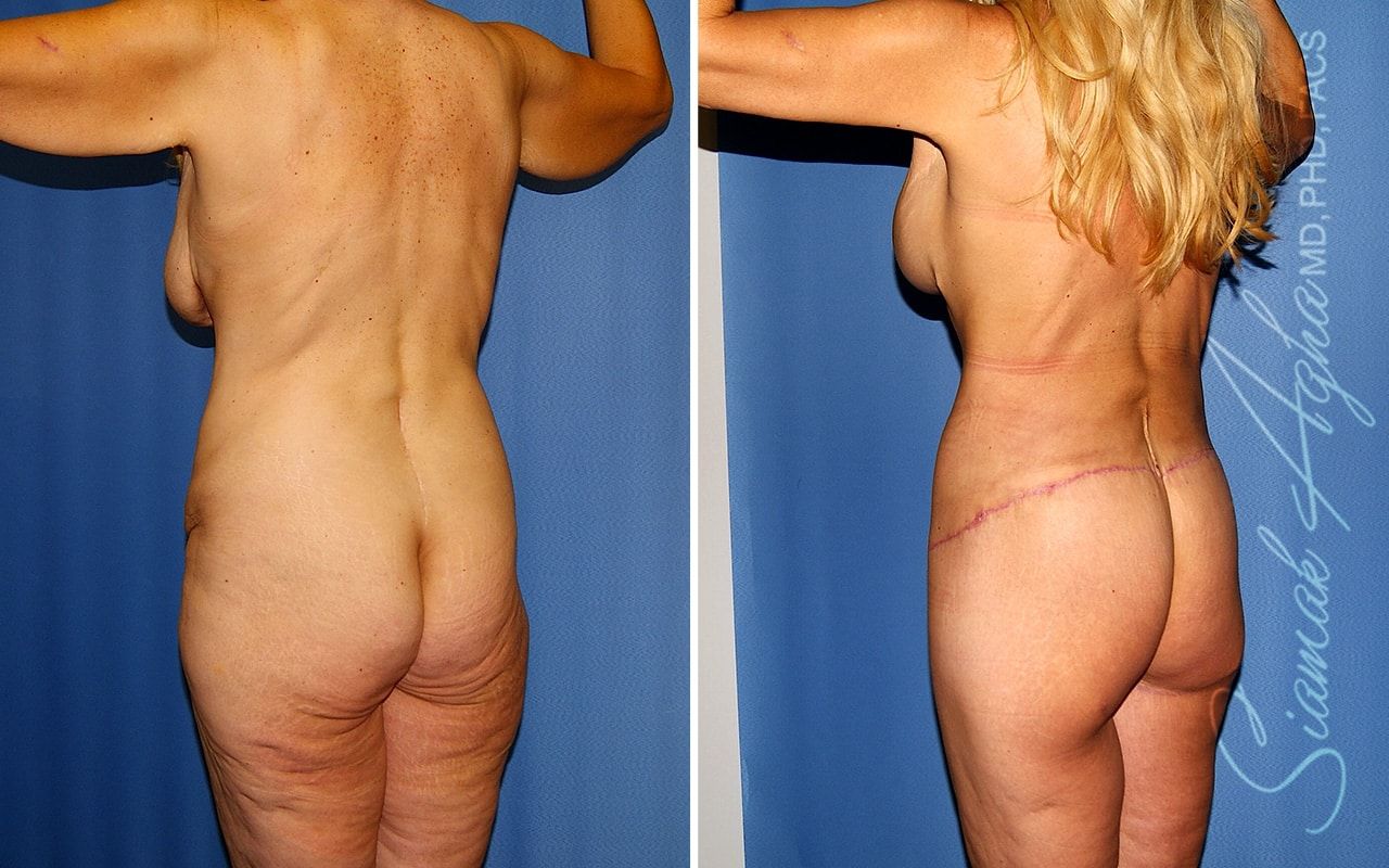 Total Body Lift Before & After