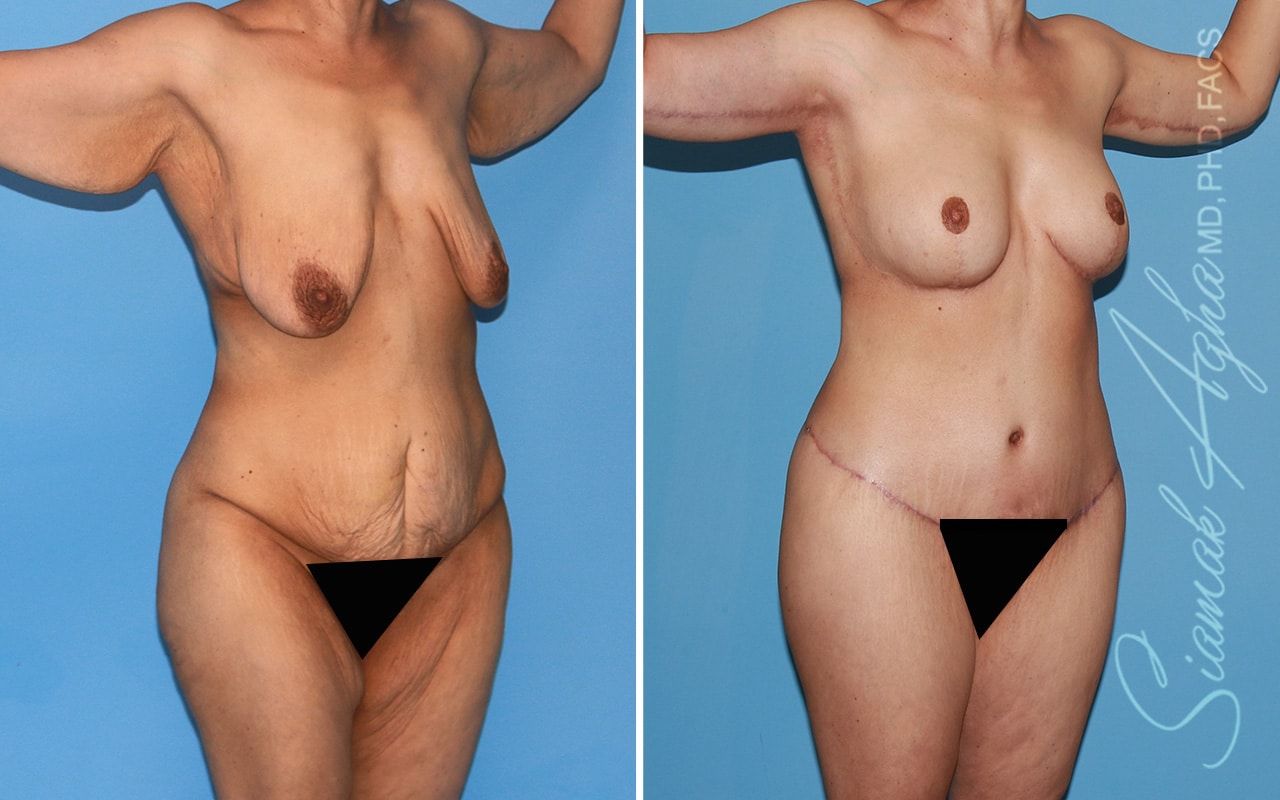 Total Body Lift Before & After