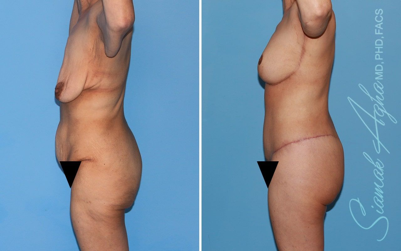 Total Body Lift Before & After