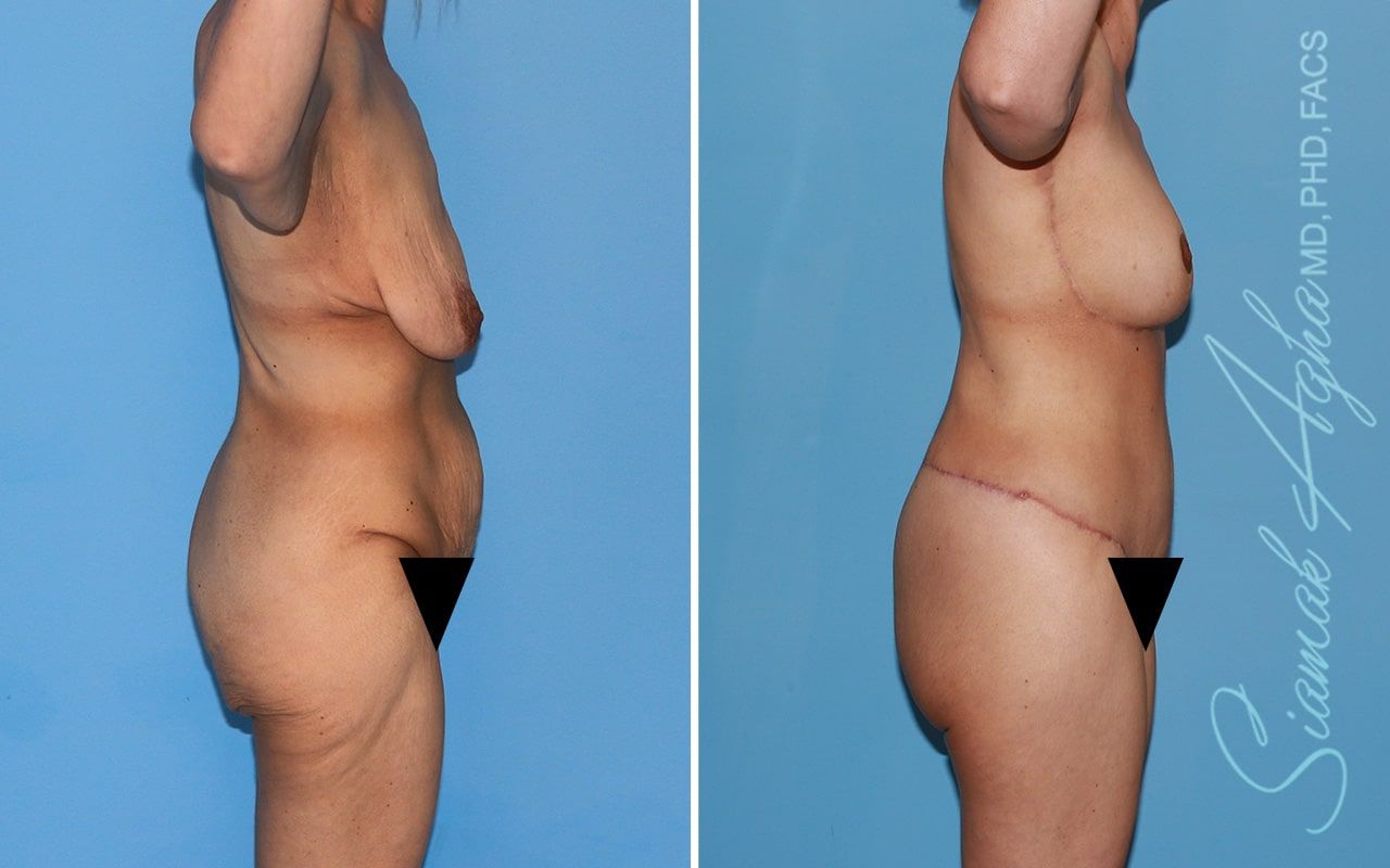 Total Body Lift Before & After