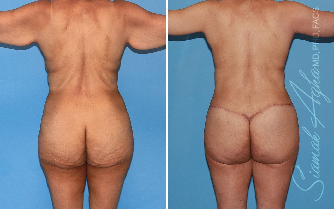 Total Body Lift Before & After