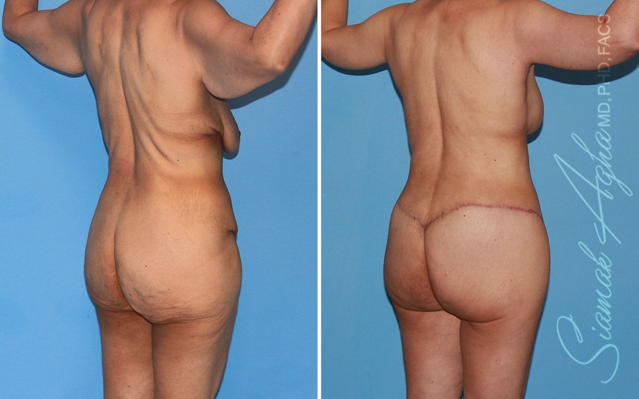 Total Body Lift Before & After