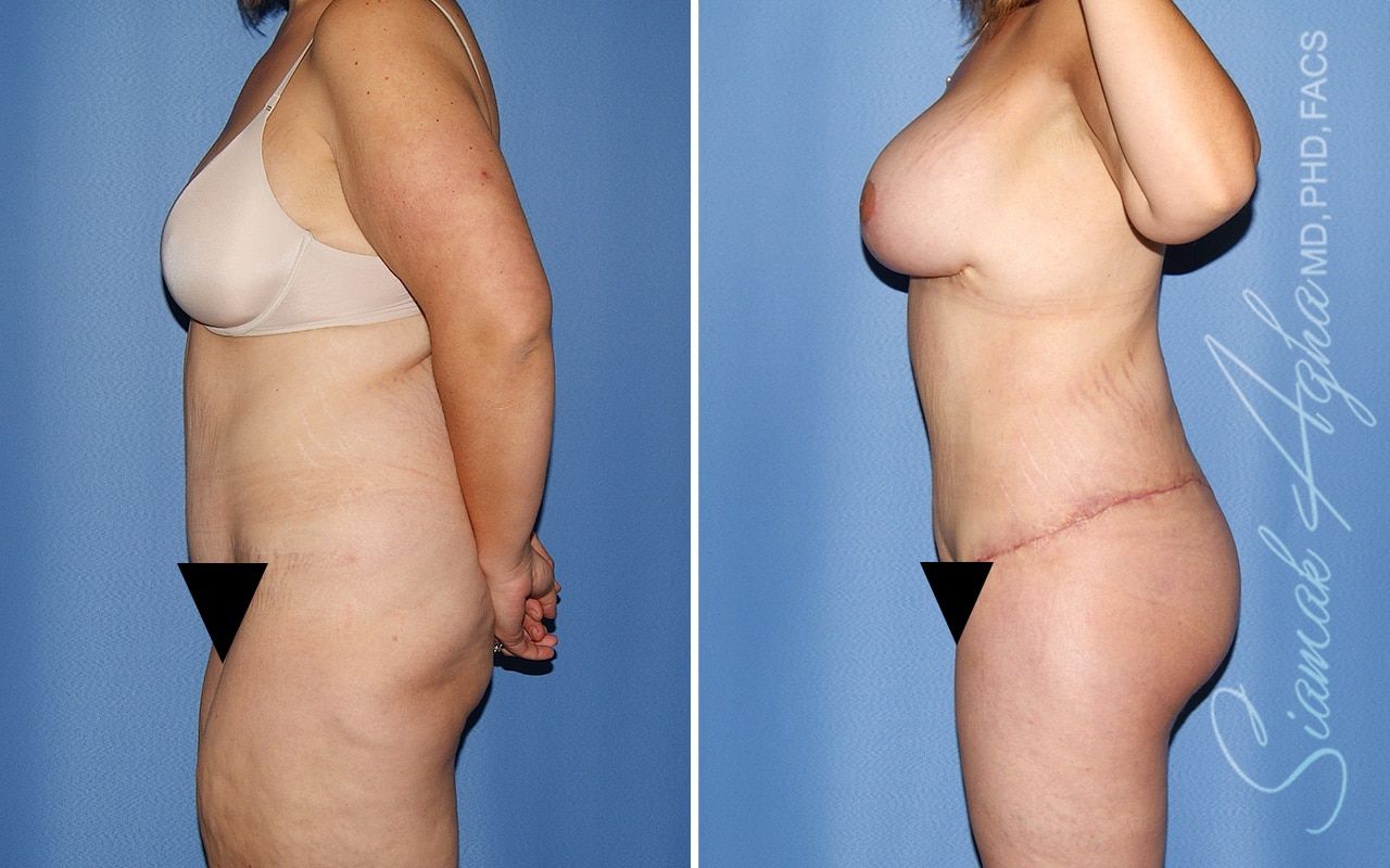 Total Body Lift Before & After