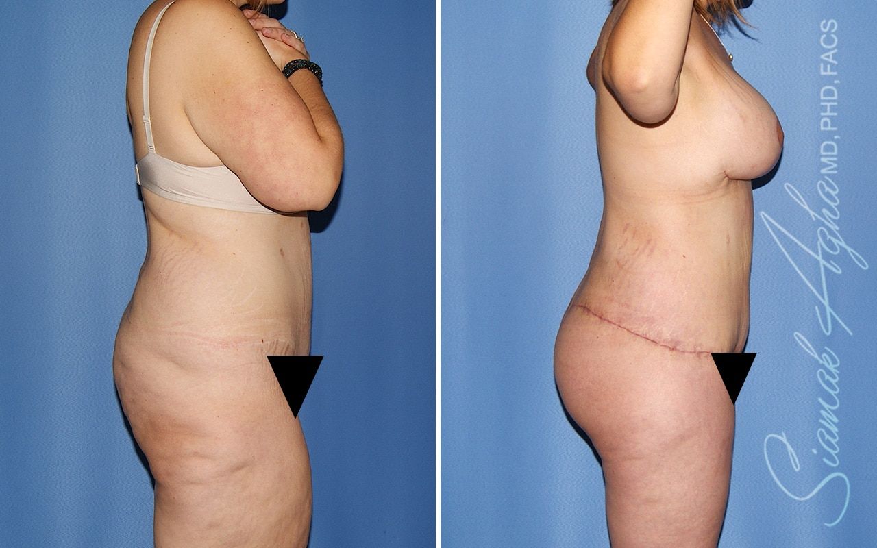 Total Body Lift Before & After