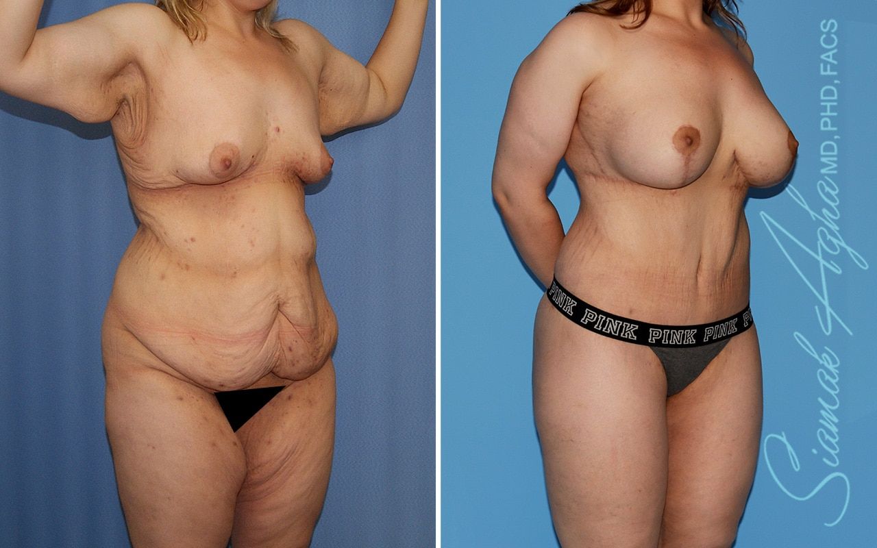 Total Body Lift Before & After