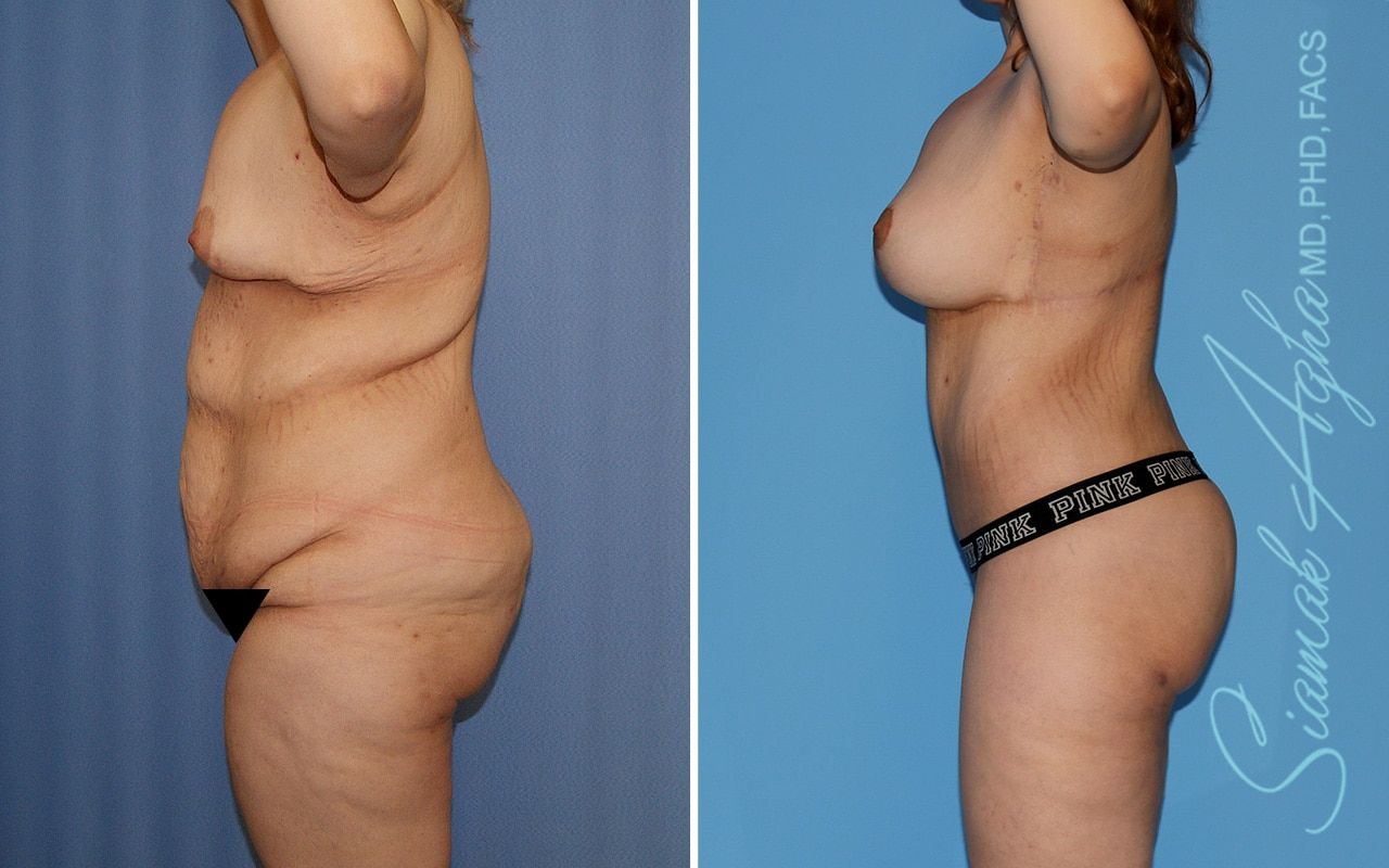 Total Body Lift Before & After