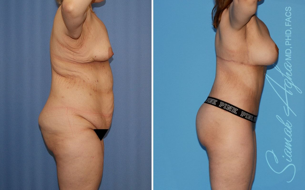 Total Body Lift Before & After