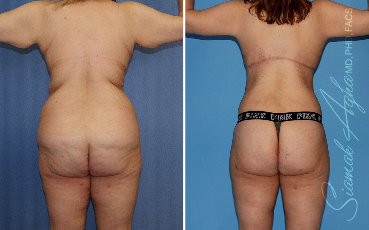 Total Body Lift Before & After