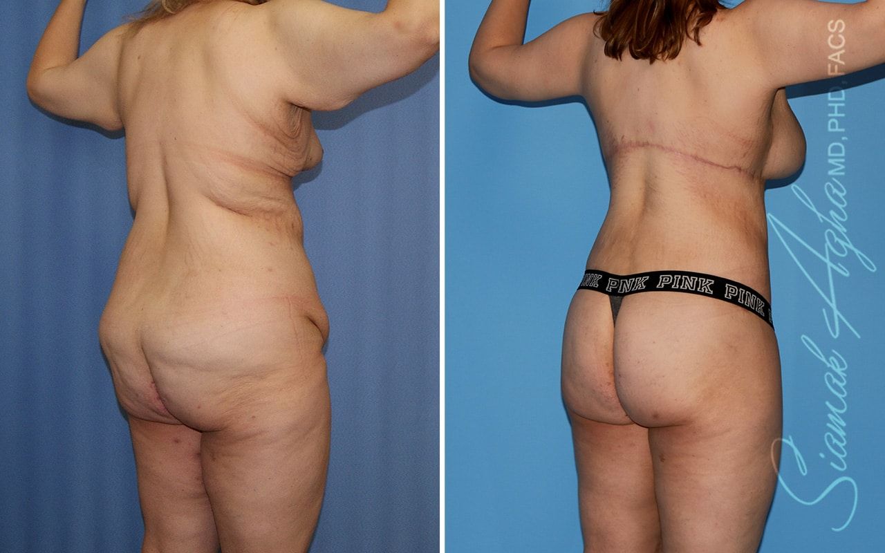 Total Body Lift Before & After