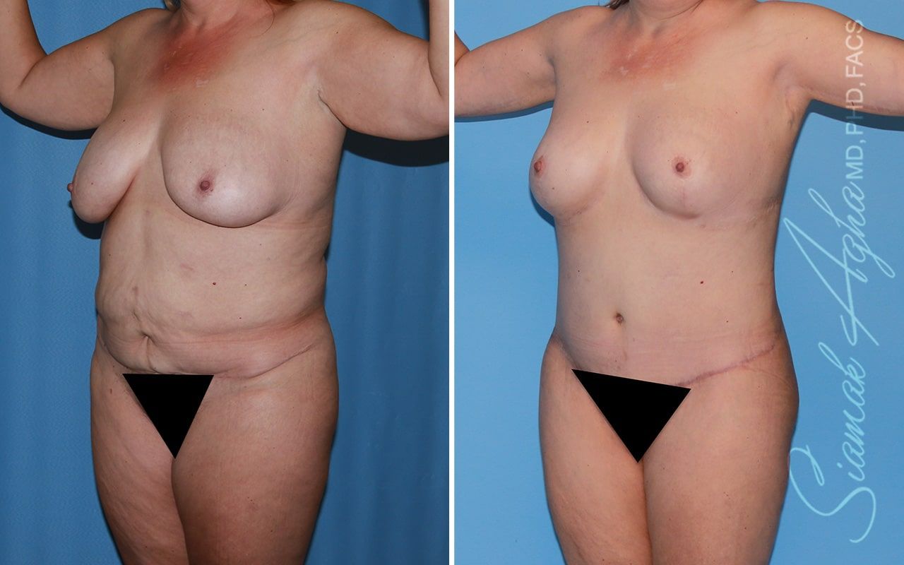 Total Body Lift Before & After