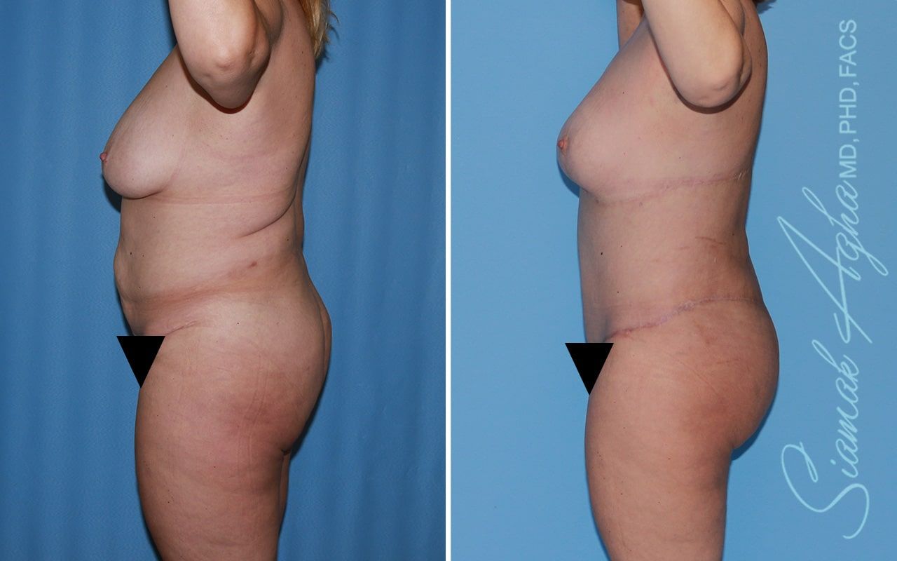 Total Body Lift Before & After