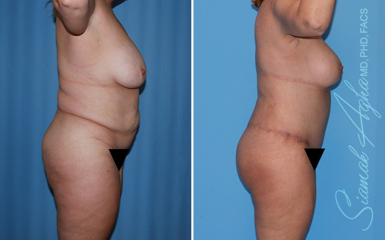 Total Body Lift Before & After