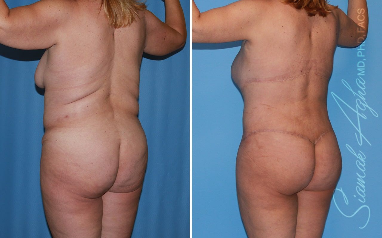 Total Body Lift Before & After