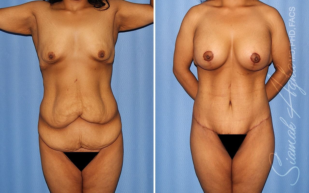 Total Body Lift Before & After