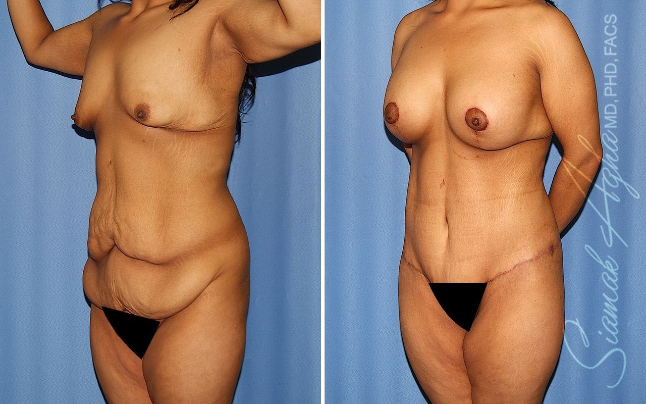 Total Body Lift Before & After