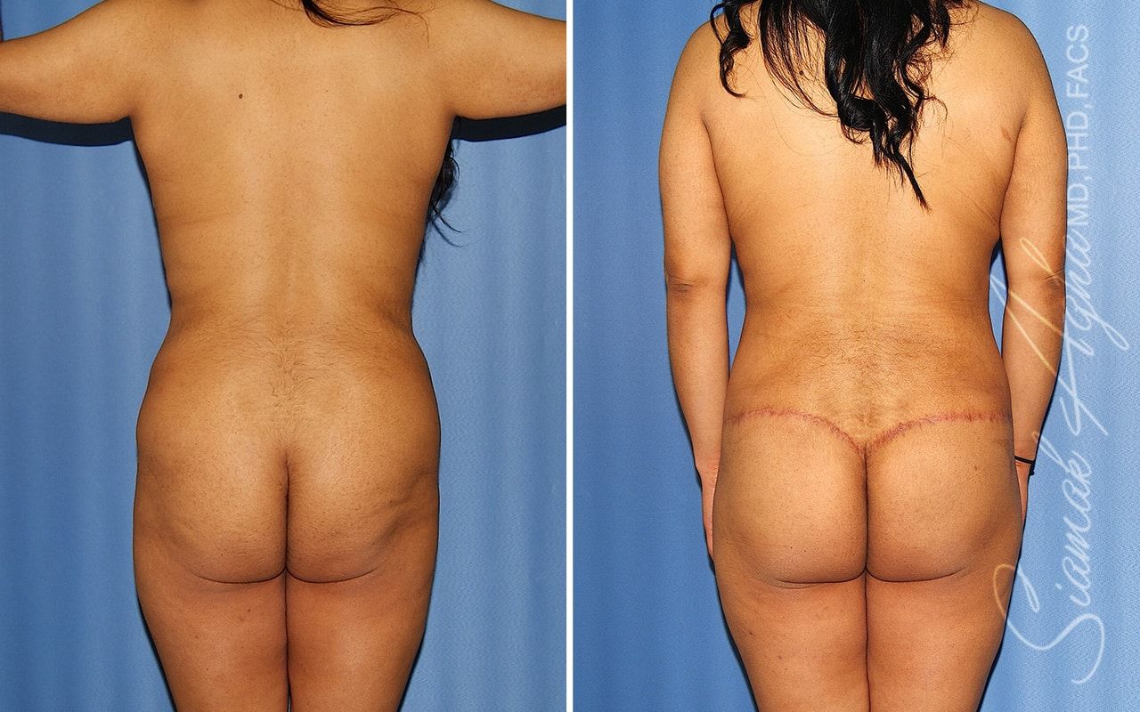 Total Body Lift Before & After