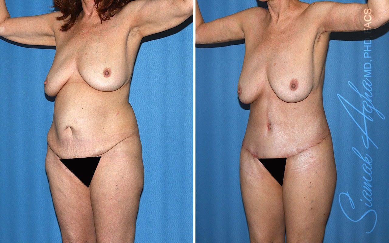 Total Body Lift Before & After