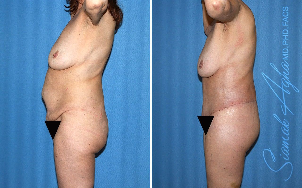 Total Body Lift Before & After