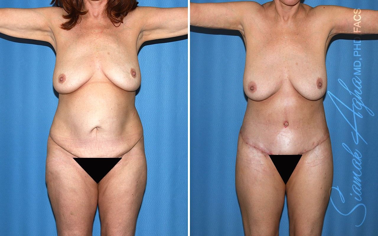 Total Body Lift Before & After