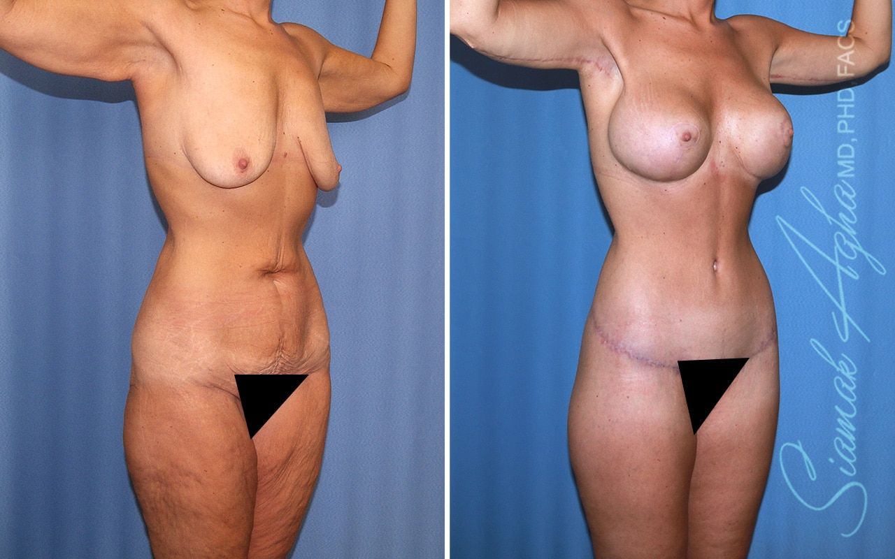Total Body Lift Before & After
