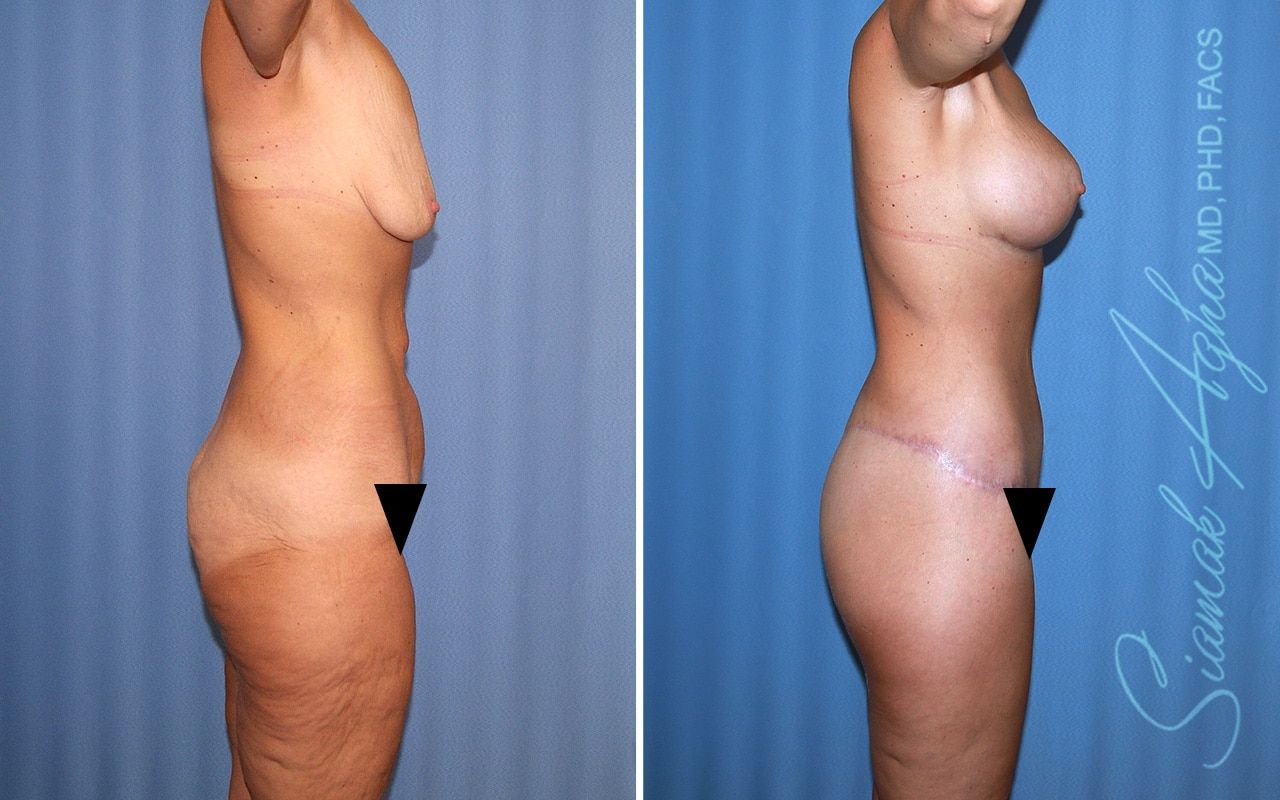 Total Body Lift Before & After