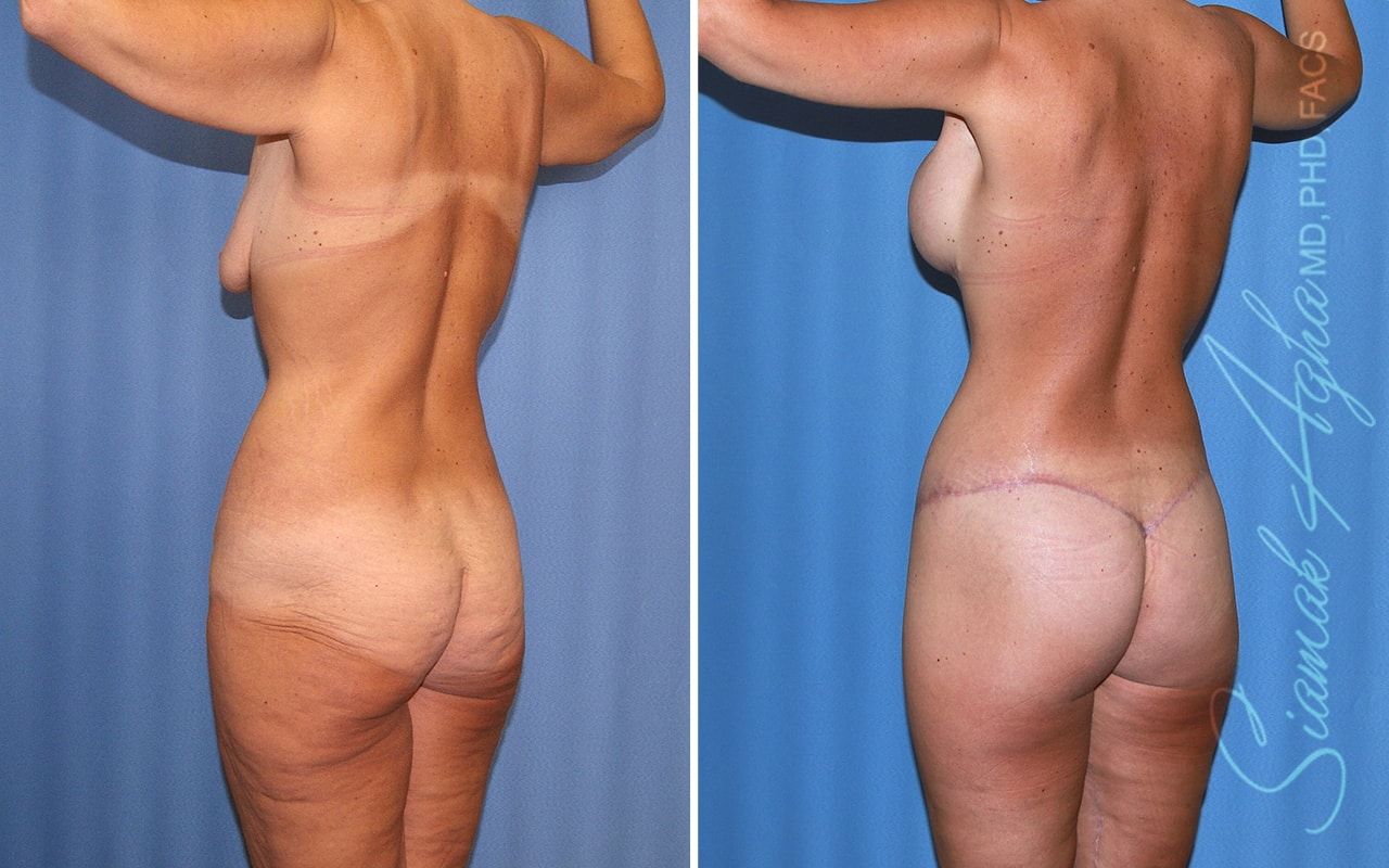 Total Body Lift Before & After