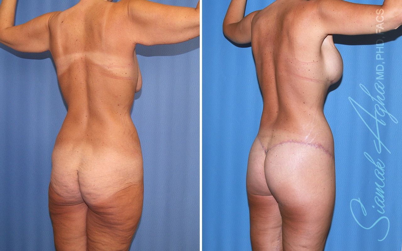 Total Body Lift Before & After