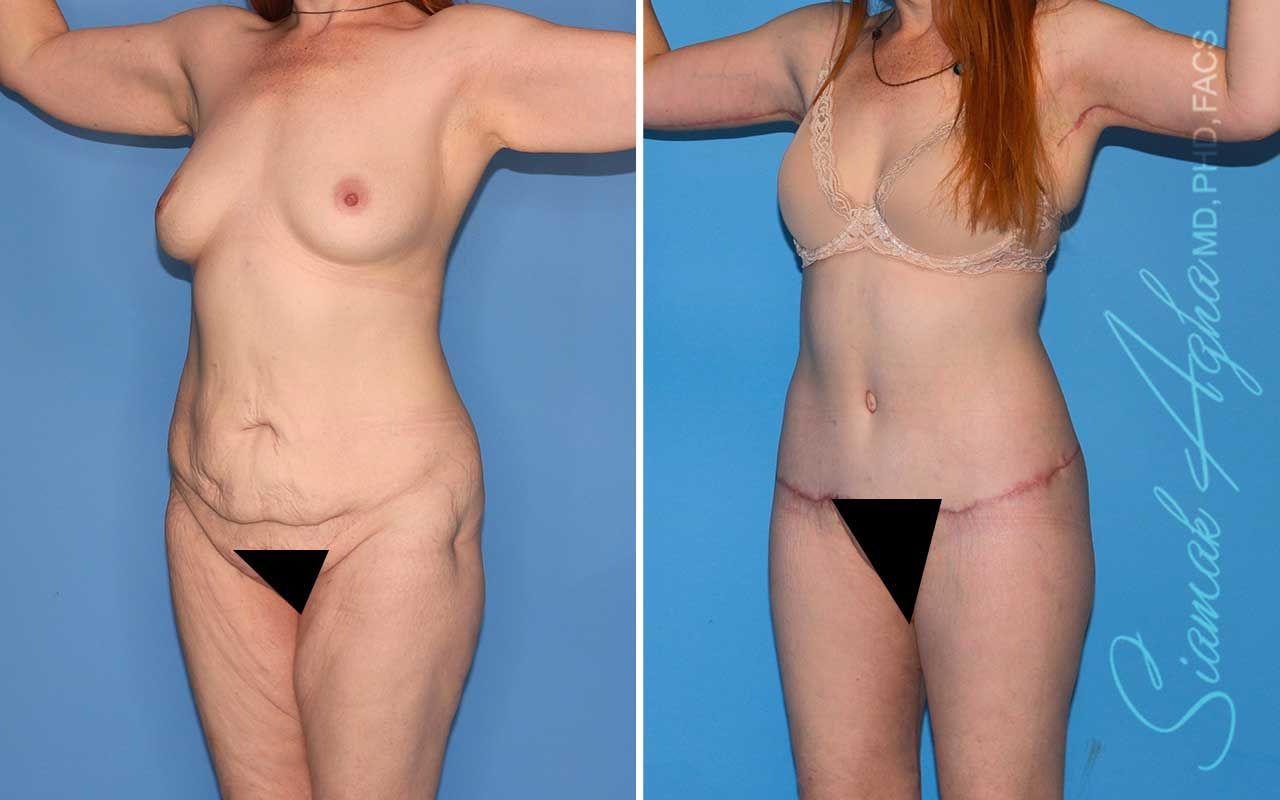 Total Body Lift Before & After