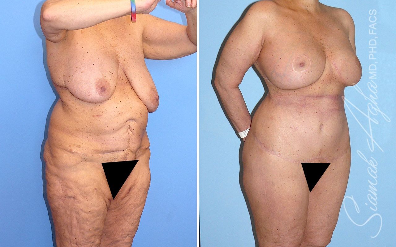 Total Body Lift Before & After