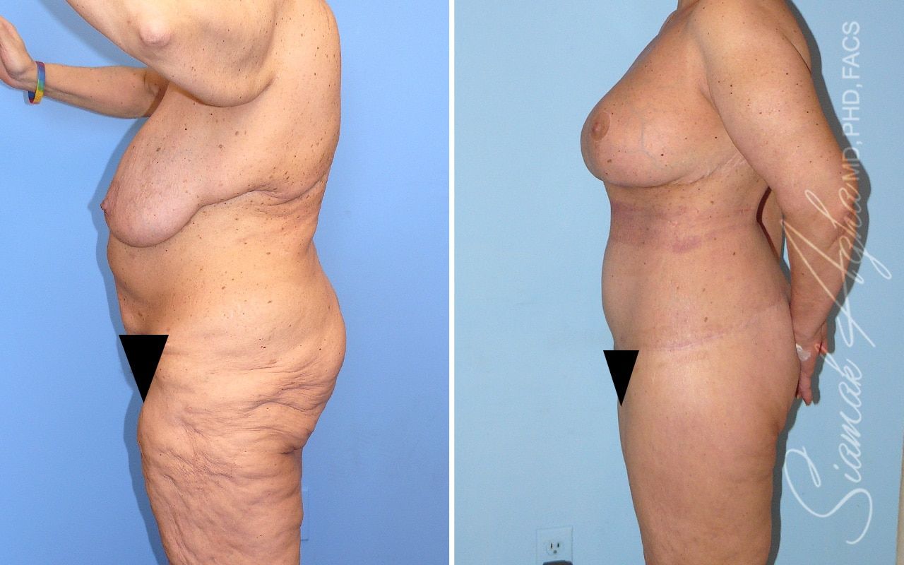 Total Body Lift Before & After