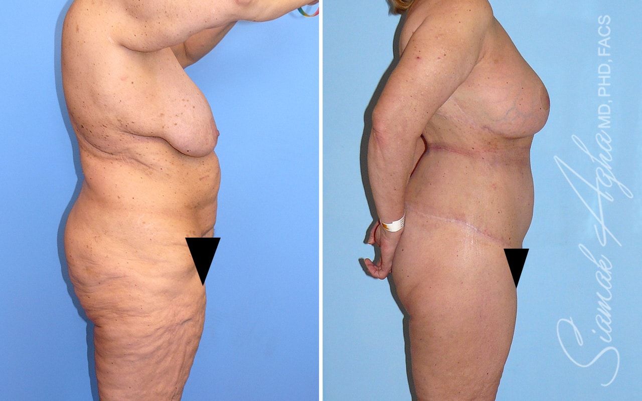 Total Body Lift Before & After