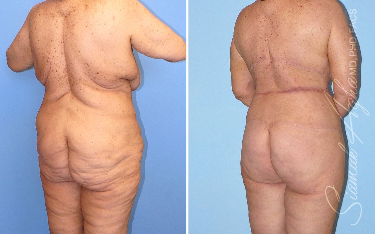 Total Body Lift Before & After