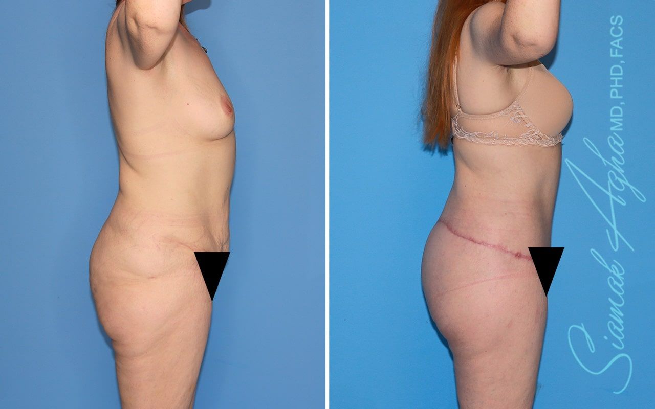 Total Body Lift Before & After