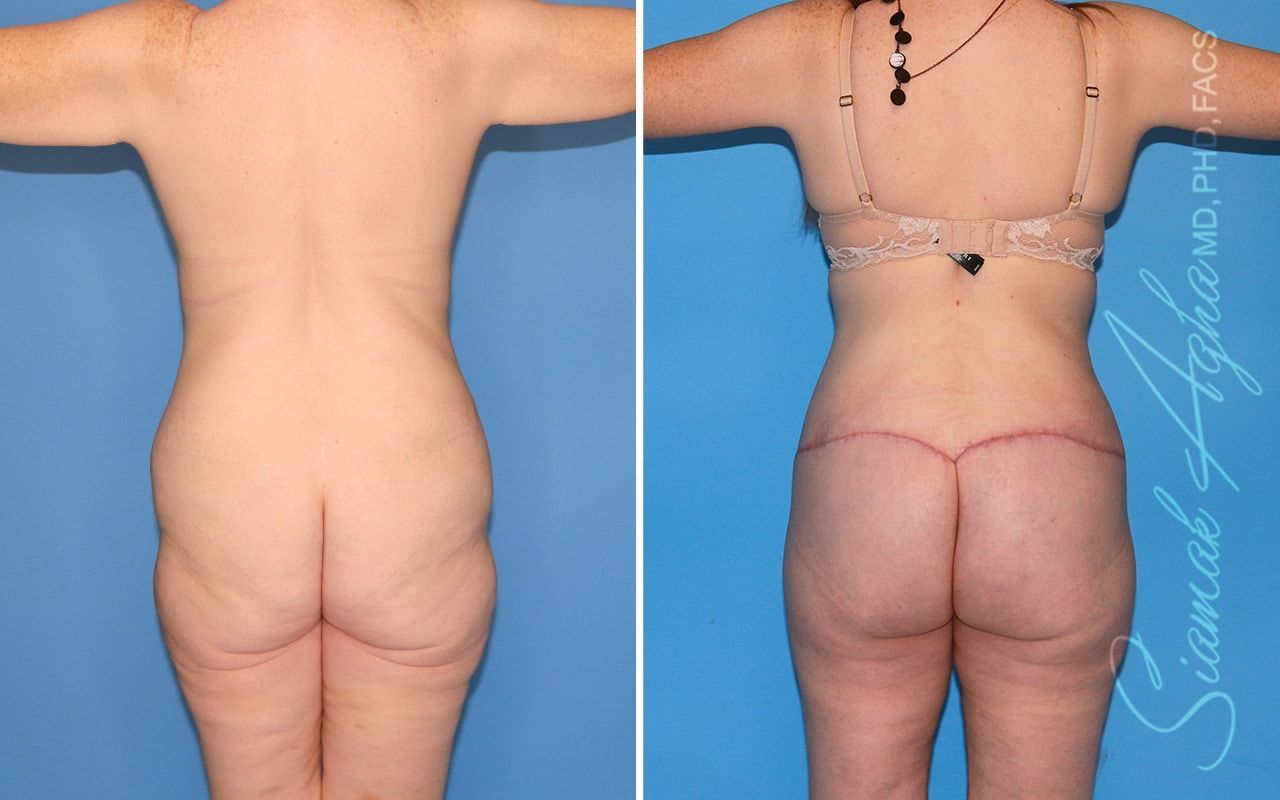 Total Body Lift Before & After