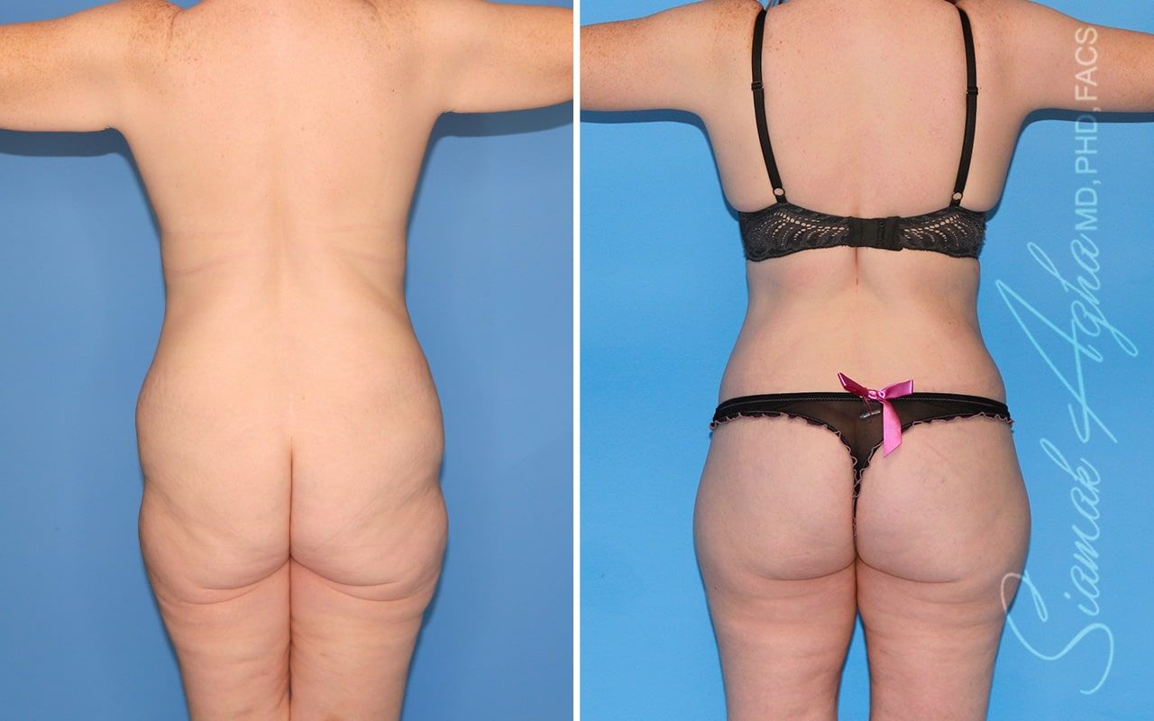 Total Body Lift Before & After