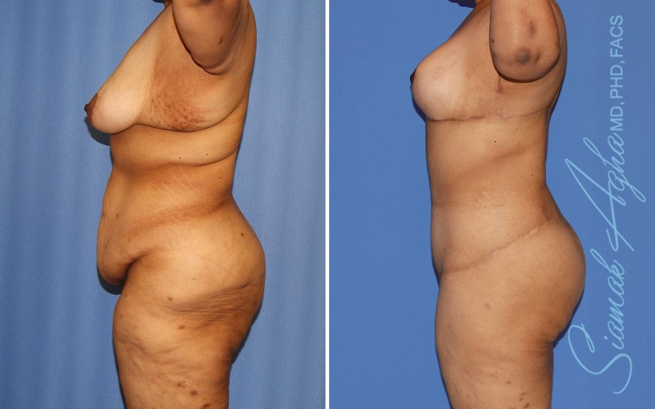 Total Body Lift Before & After