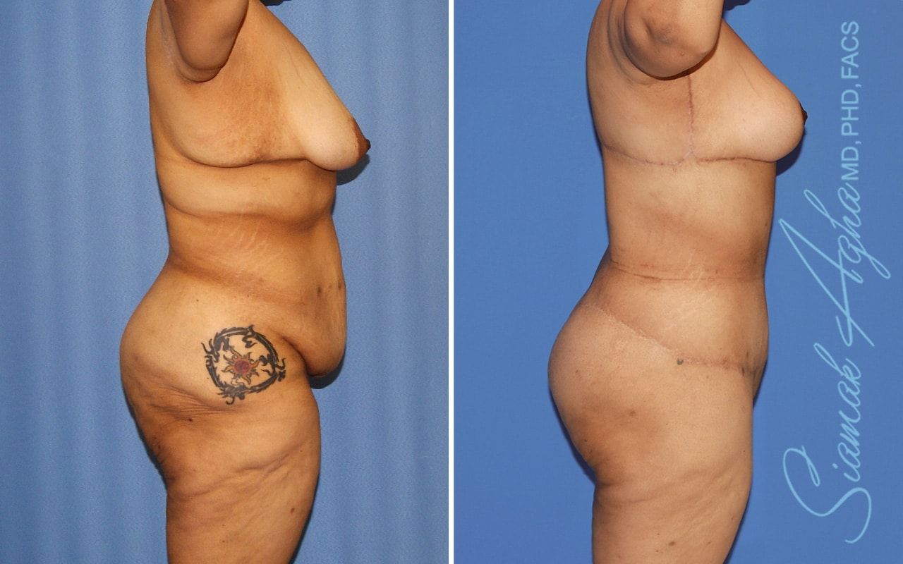 Total Body Lift Before & After