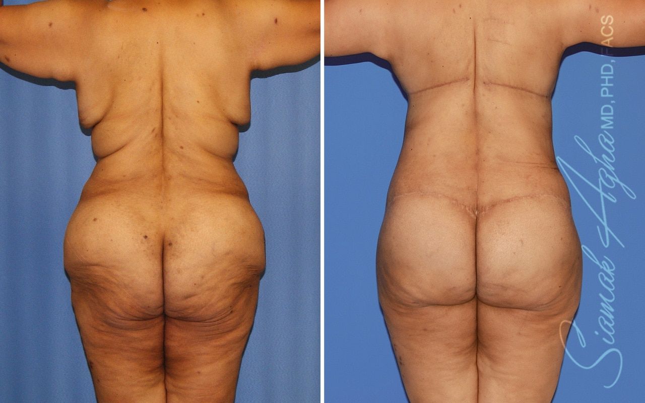 Total Body Lift Before & After