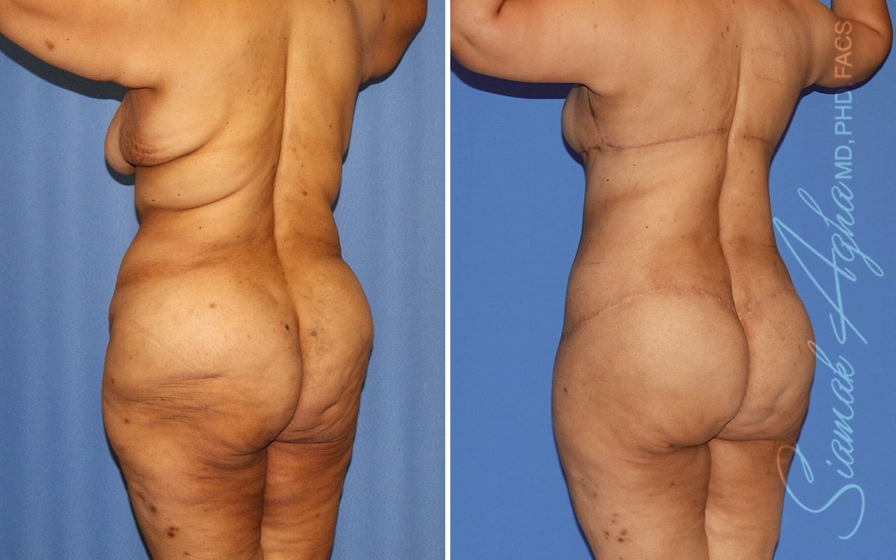 Total Body Lift Before & After