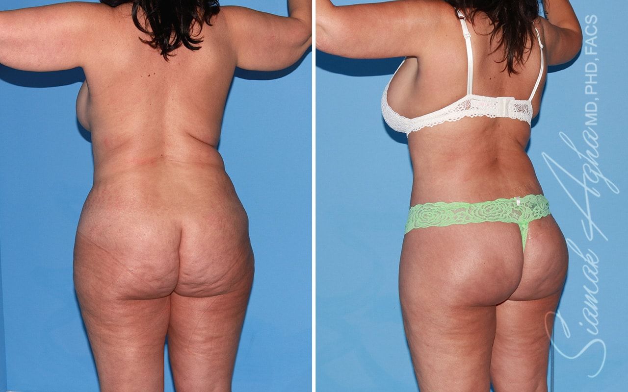 Total Body Lift Before & After